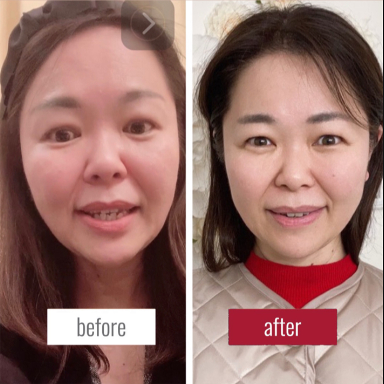 150代ビフォーアフター】ちおり式小顔矯正で結果が出ています