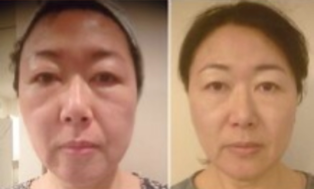 【老化予防】に小顔矯正が効果的な圧倒的な理由！！