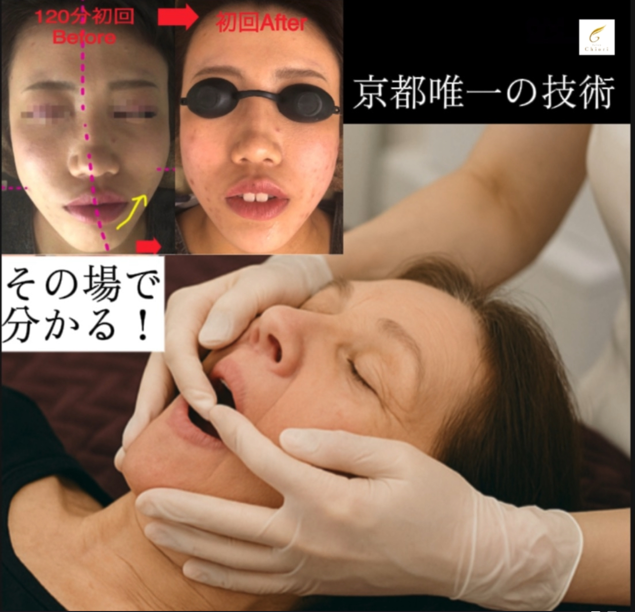 《サロンチオリのオリジナル技術》口内アプローチで小顔×たるみ改善