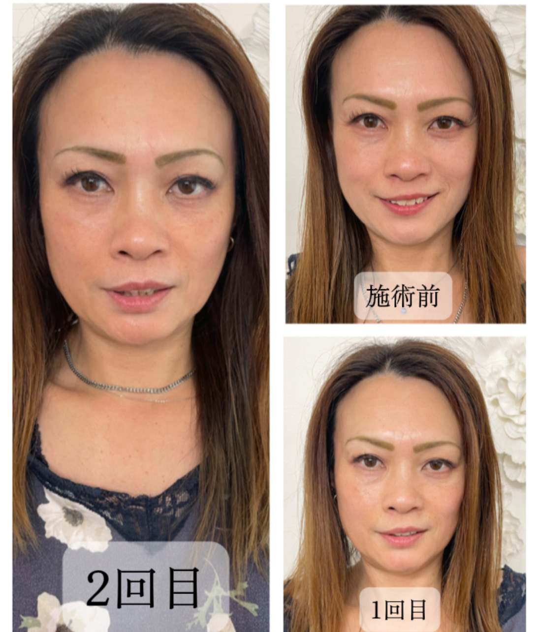 顔が激変⁉︎ 話題の口内矯正！