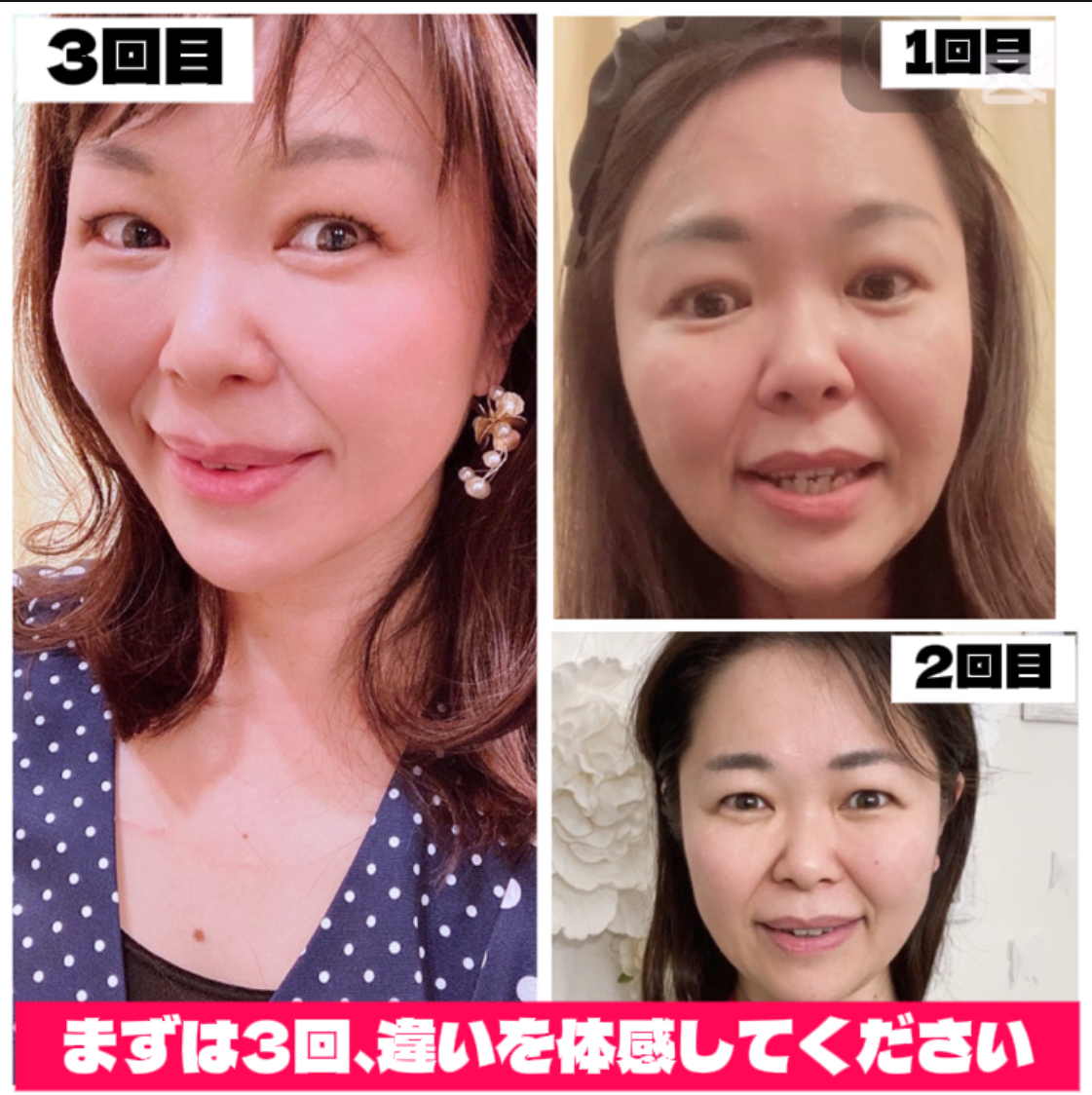 顔のたるみ・ほうれい線・フェイスラインの崩れ