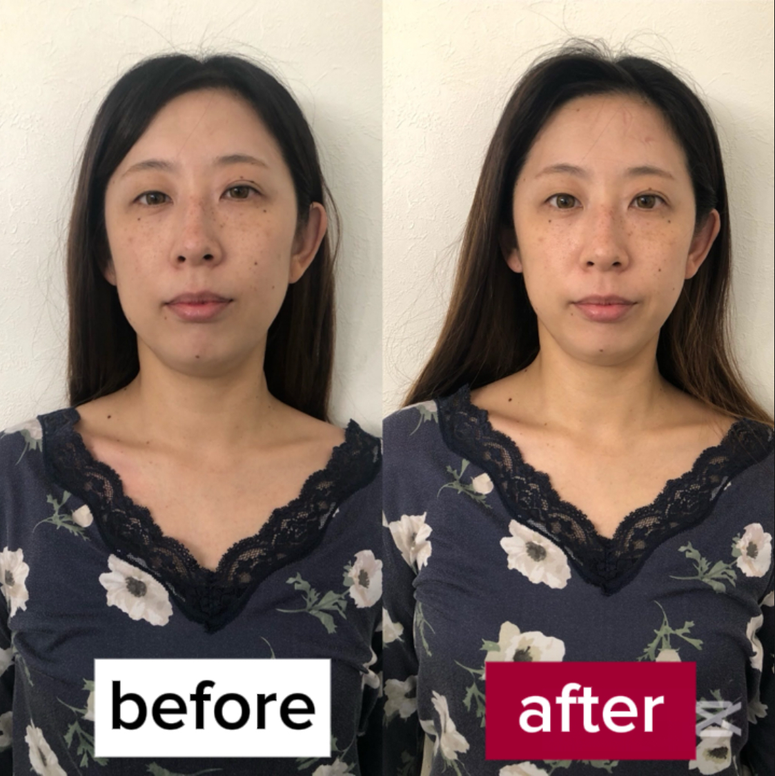 ＜深いたるみも変わる！＞ちおり式小顔矯正