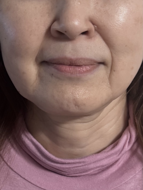 「二重アゴは脂肪？姿勢？それともゆがみ？」