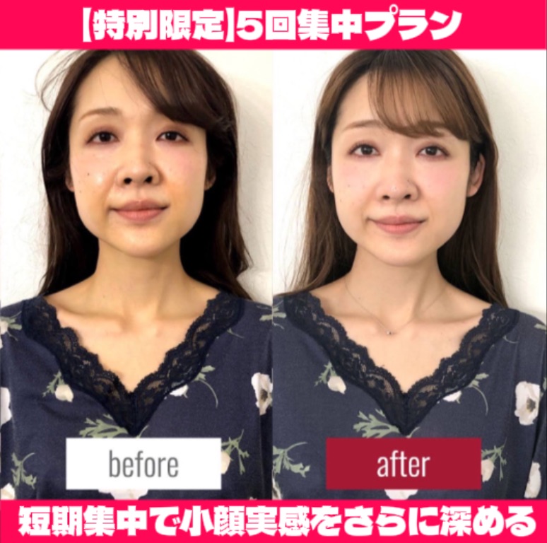 年末までに整う！小顔矯正【短期集中5回プラン】でたるみ・左右差改善